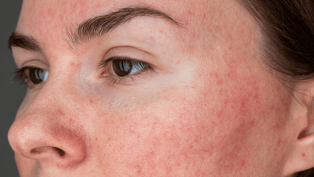 Colostrum Hydrofluid and Rosacea