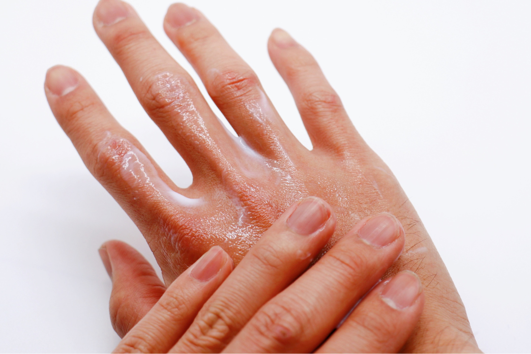 Dry hands in winter